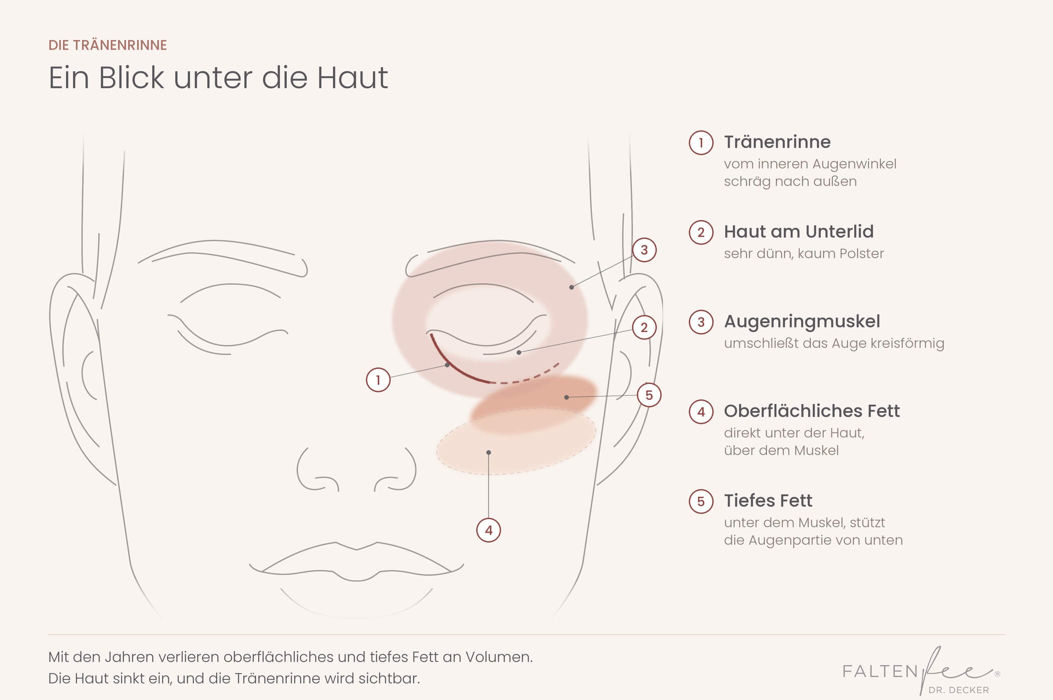 Schematische Darstellung der Augenpartie mit Augenringmuskel, oberflächlichem und tiefem Fett und Tränenrinne – FALTENFEE® Dortmund